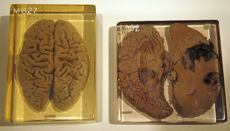 Albert Einsteins Brain on Display at London Wellcome Exhibition 380 Albert Einsteins Brain on Display at London Wellcome Exhibition
