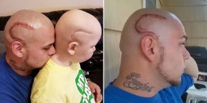 Dad Gets Matching Tattoo Of Son’s Cancer Scar For Solidarity
