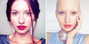 Doctors Told Model With Jaw Cancer To Have An Abortion, So This Is What She Did