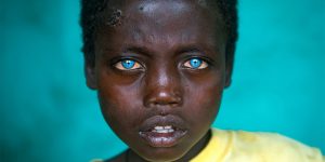 Abushe, An African Child With Plastic Eyes