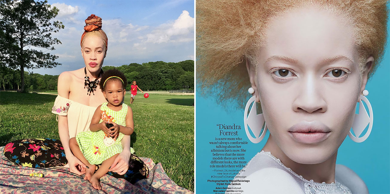 Meet Diandra Forrest Stunning Albino African American Model