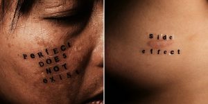 This Photographer Takes Beautiful Portraits Of People With Acne