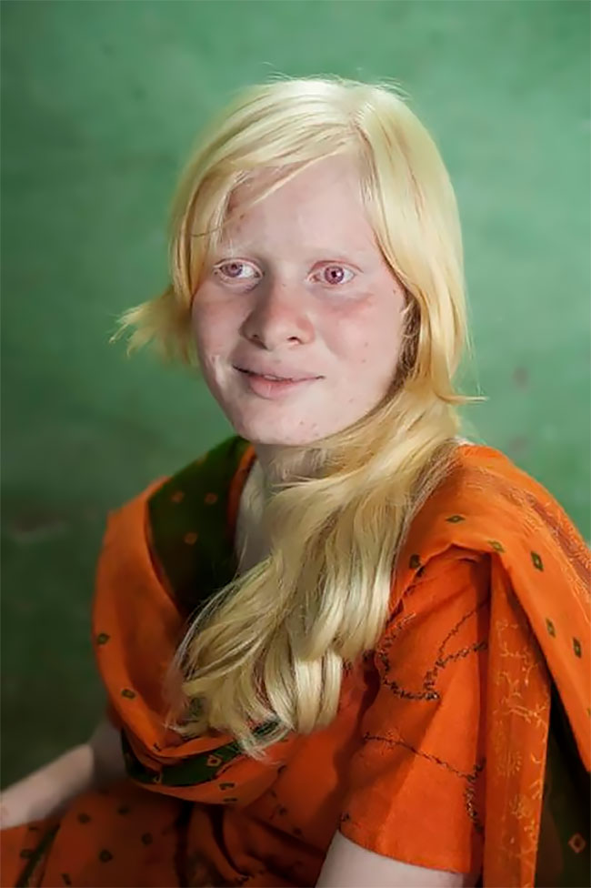 albino indian family