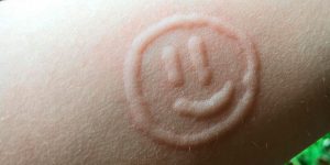 Teen Allergic to Touch Uses Her Own Body as Human Etch-a-Sketch