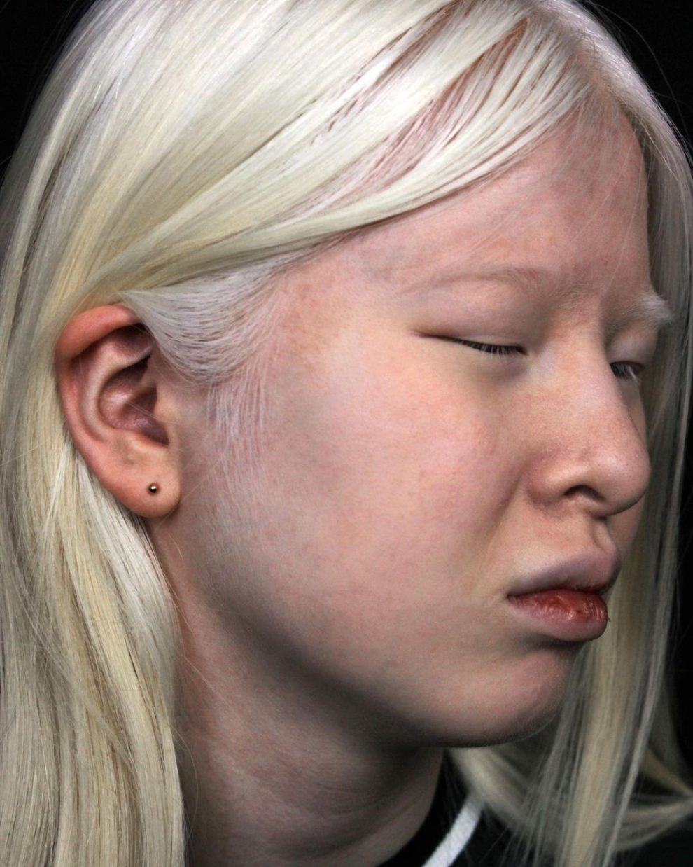 Abandoned As A Baby Due To Albinism, Xueli Grew Up To Become A Vogue ...