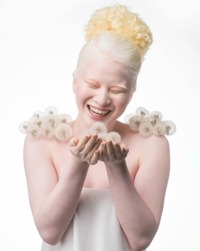 Abandoned As A Baby Due To Albinism, Xueli Grew Up To Become A Vogue ...