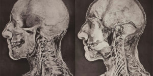 Amazing Anatomical Photographs from Alec Fraser's Handbook of Brain Surgery, 1890