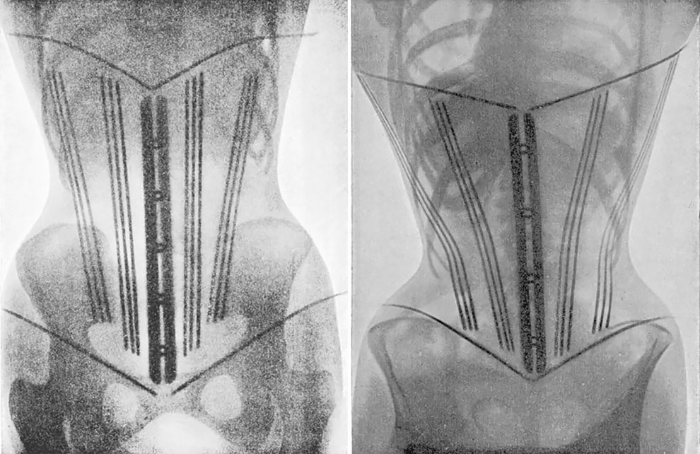 In 1908, a Doctor Used X-Rays to Highlight the Damaging Effects of Tight  Corsets on a Woman's Body » Design You Trust