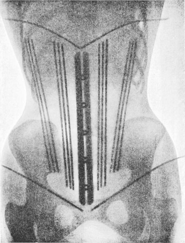 corset-x-rays-of-dr-ludovic-o-followell-1