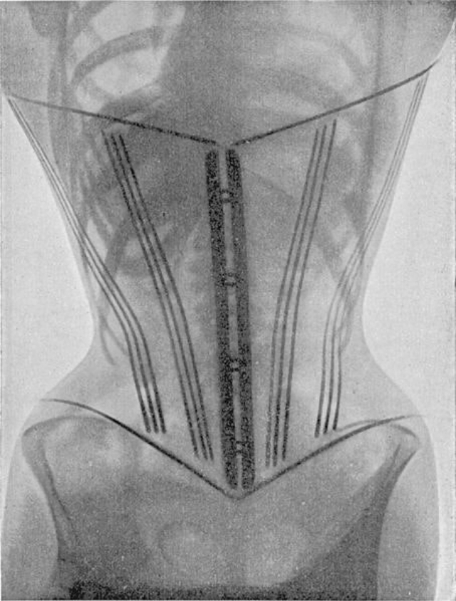 corset-x-rays-of-dr-ludovic-o-followell-2