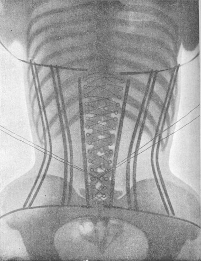 corset-x-rays-of-dr-ludovic-o-followell-4