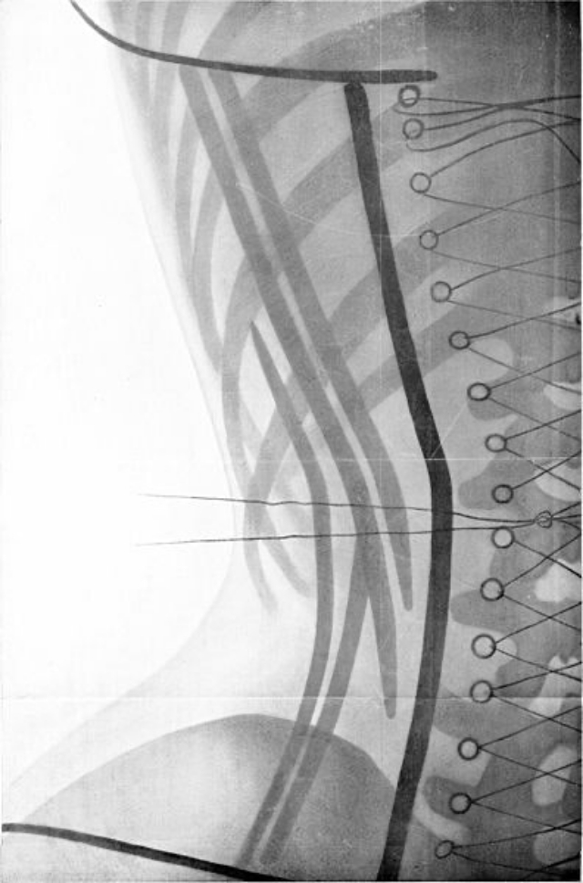 corset-x-rays-of-dr-ludovic-o-followell-6