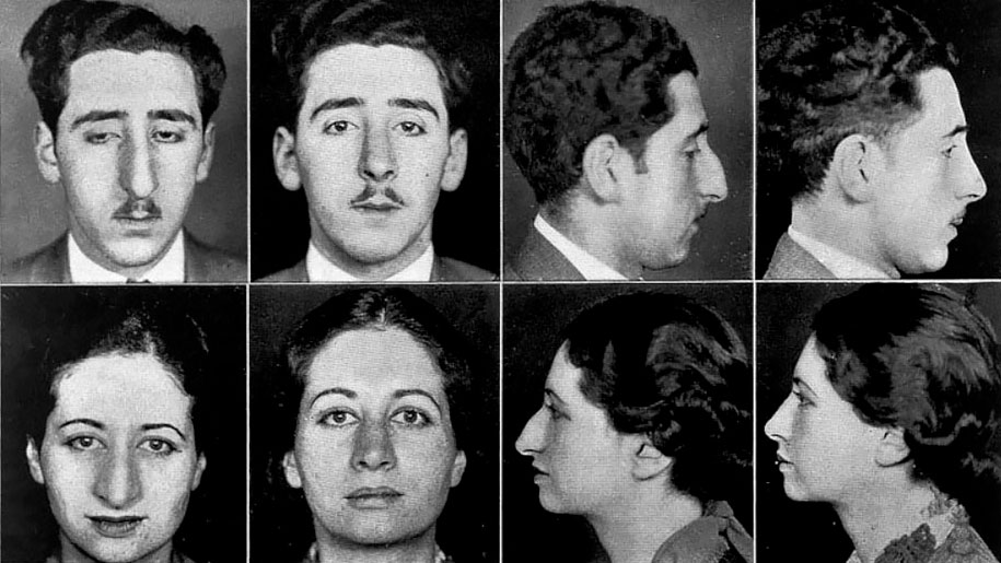 Stunning Examples of the Rhinoplasty Surgery from the 1920s and 1930s - Vimarsana News