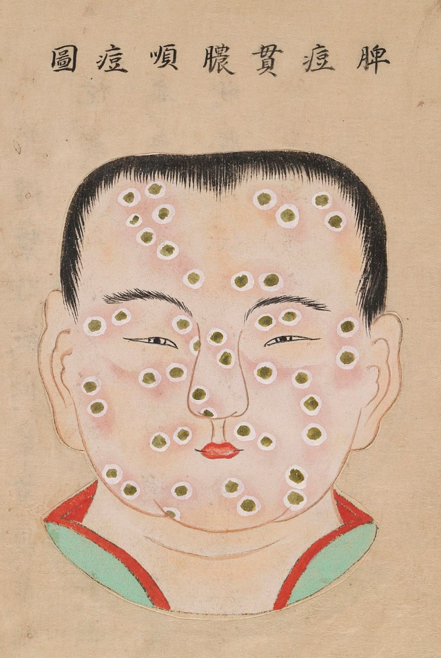 1720 Smallpox Illustration 10