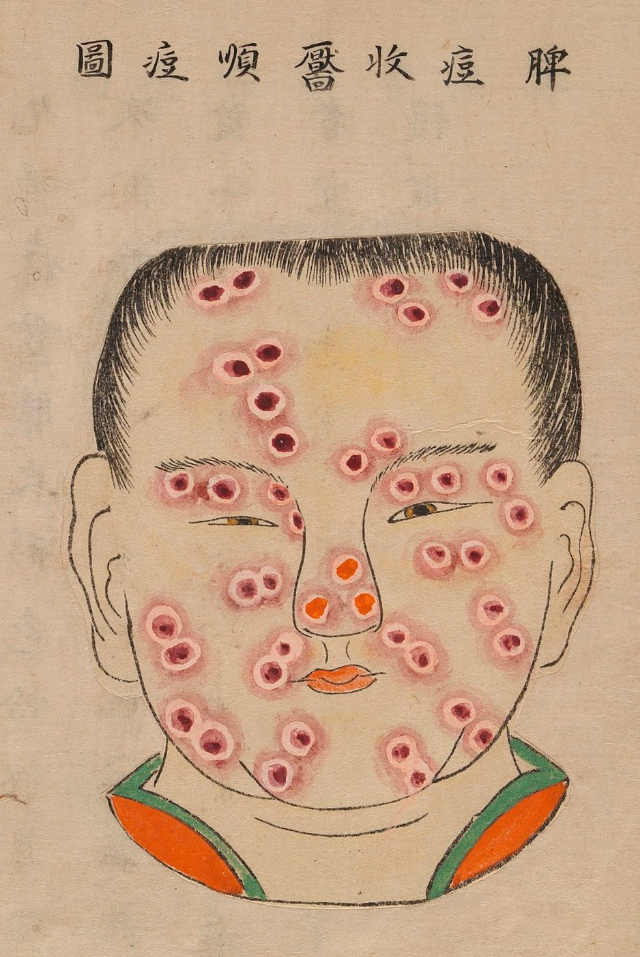 1720 Smallpox Illustration 11