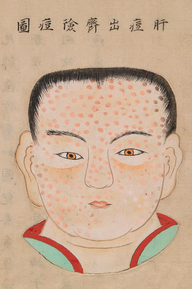 1720 Smallpox Illustration 12