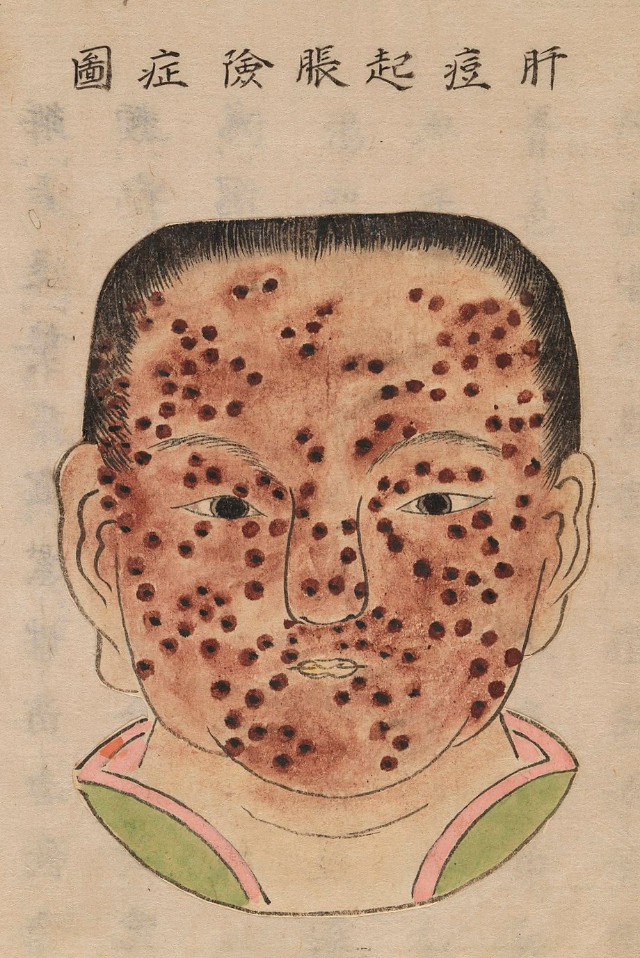 1720 Smallpox Illustration 13