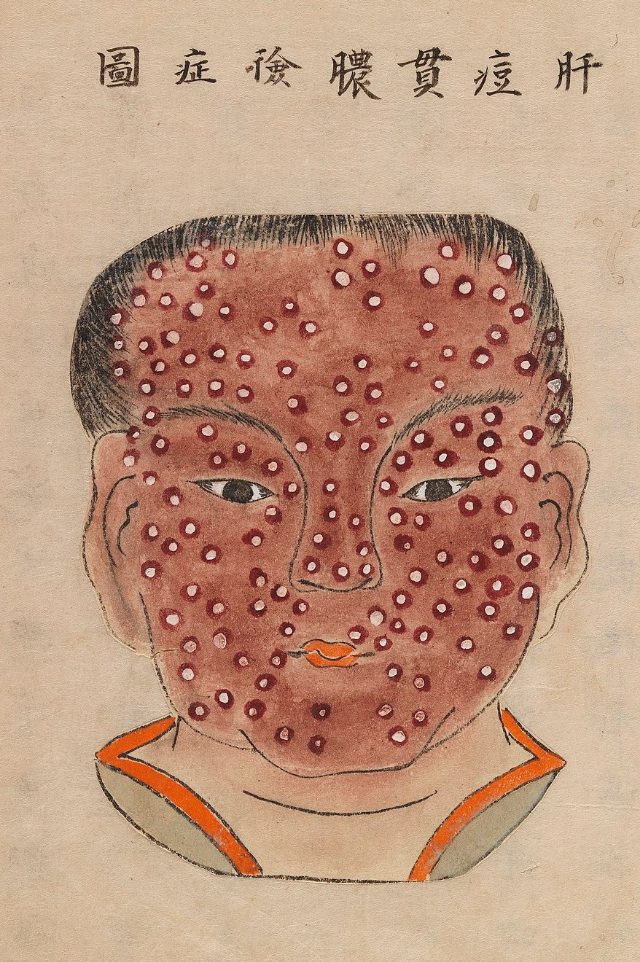 1720 Smallpox Illustration 14