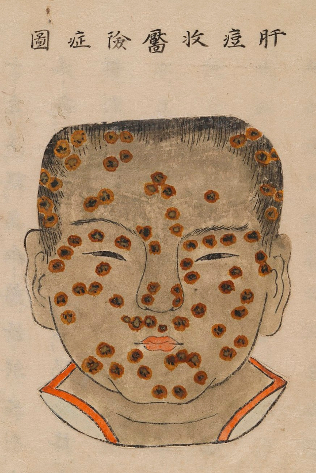 1720 Smallpox Illustration 15