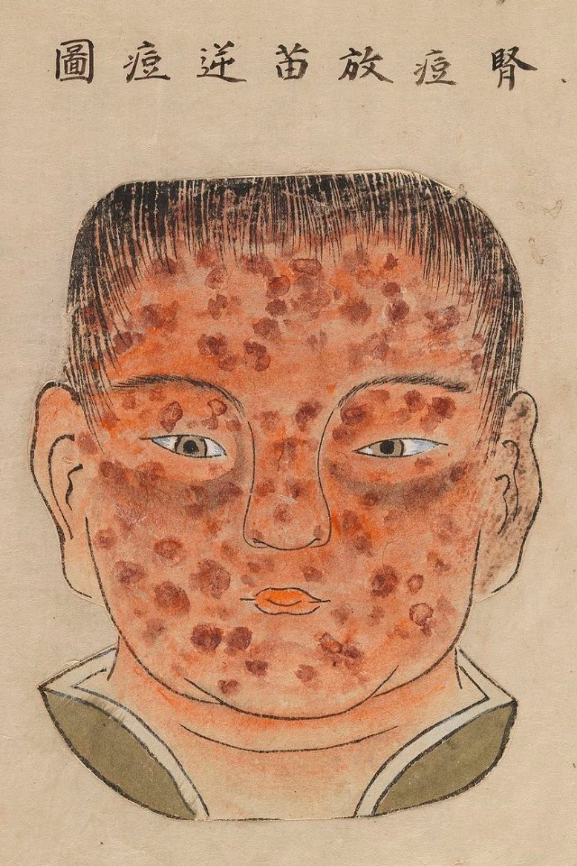 1720 Smallpox Illustration 16