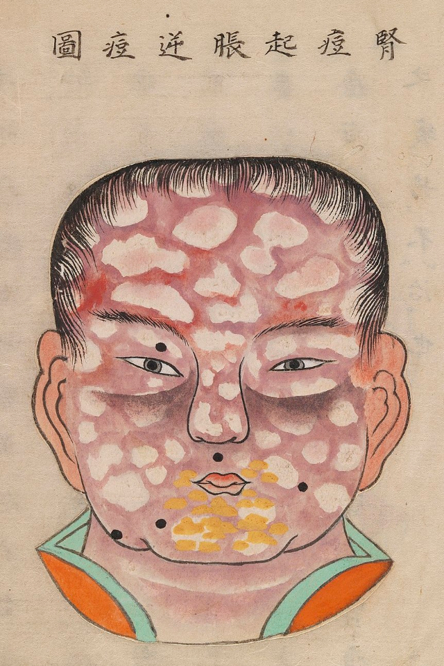 1720 Smallpox Illustration 17