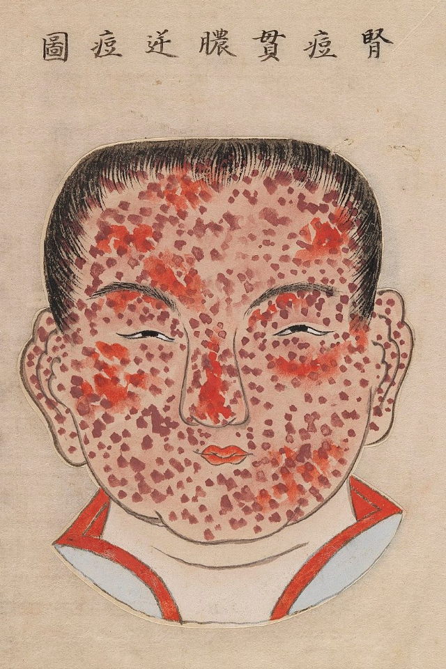1720 Smallpox Illustration 18