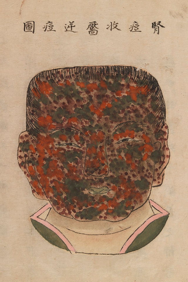 1720 Smallpox Illustration 19