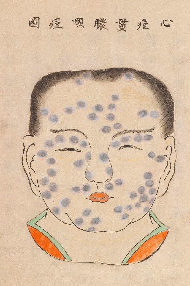 1720 Smallpox Illustration 2