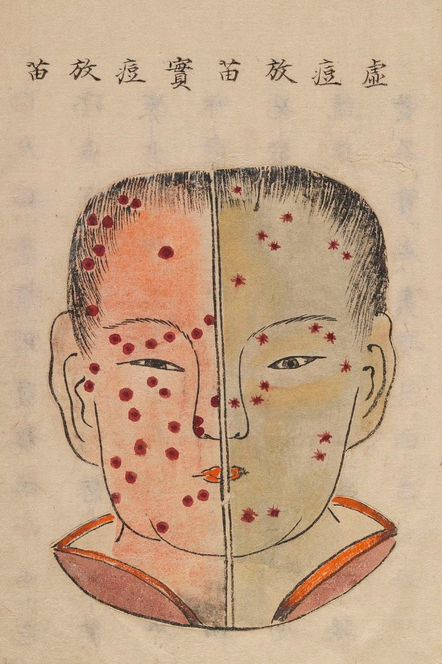 1720 Smallpox Illustration 20