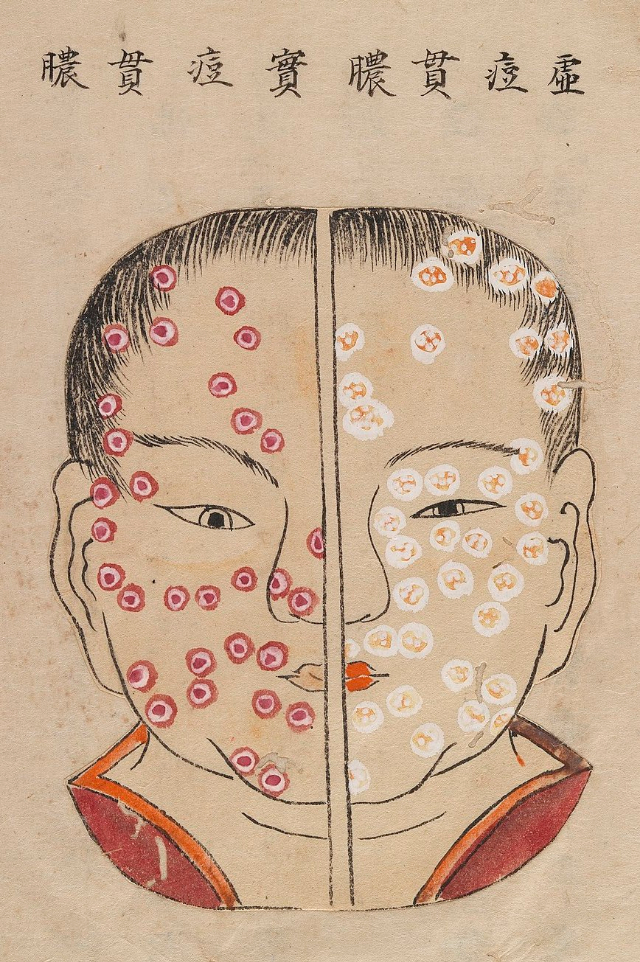 1720 Smallpox Illustration 21