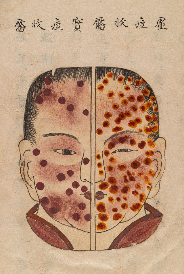 1720 Smallpox Illustration 22