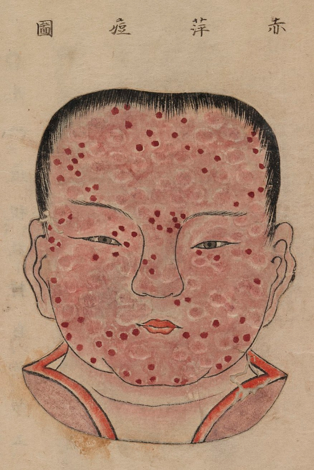 1720 Smallpox Illustration 23