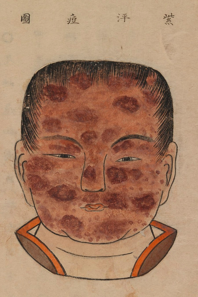 1720 Smallpox Illustration 24