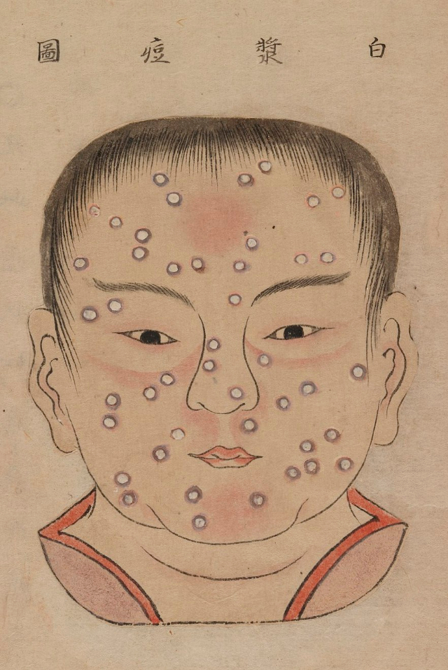 1720 Smallpox Illustration 26