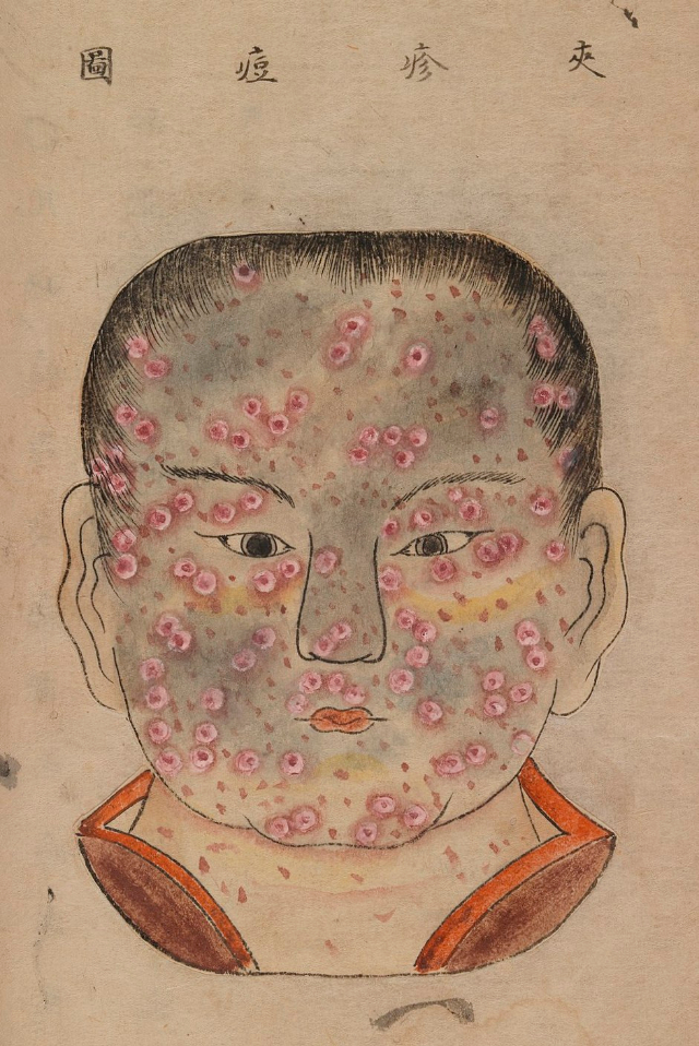 1720 Smallpox Illustration 27