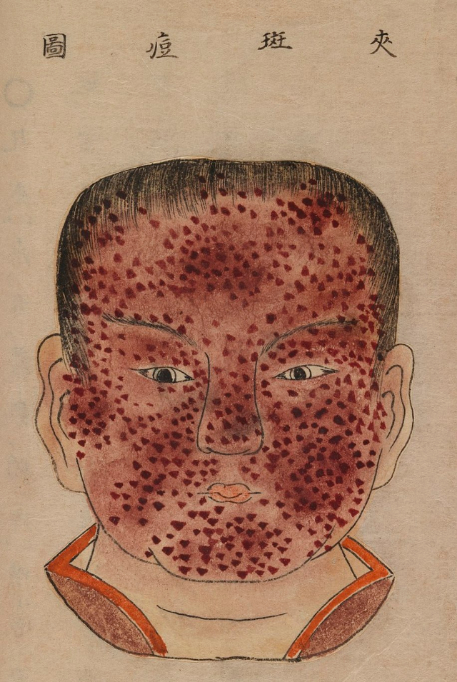 1720 Smallpox Illustration 28