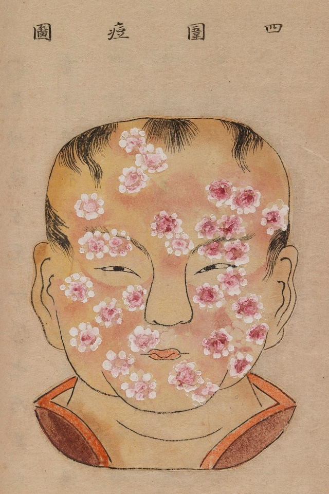 1720 Smallpox Illustration 29