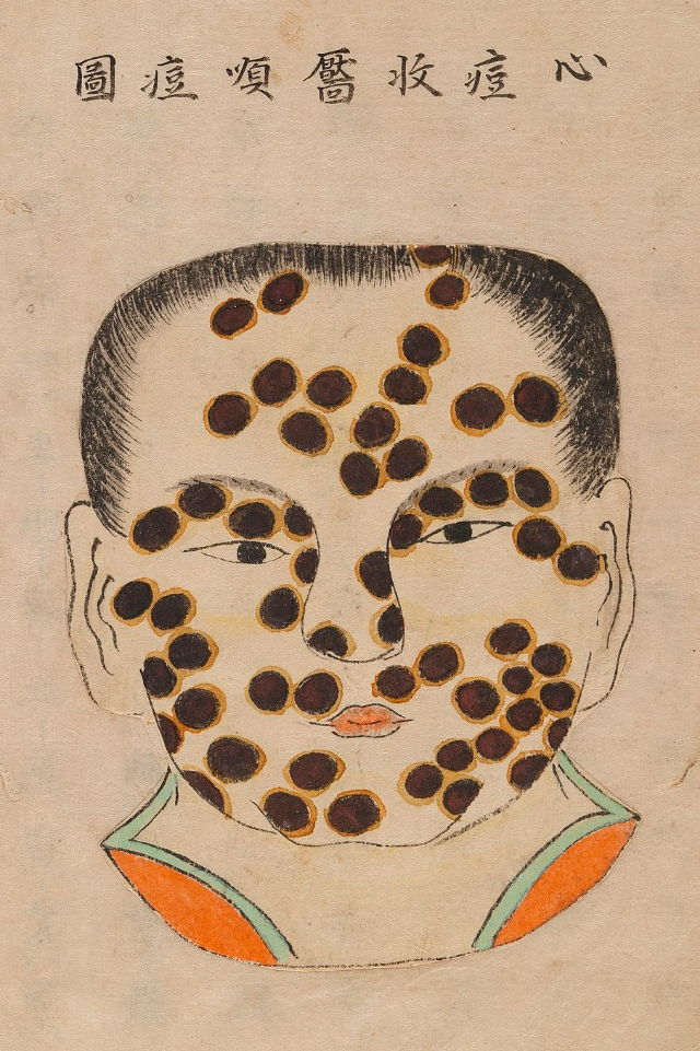 1720 Smallpox Illustration 3