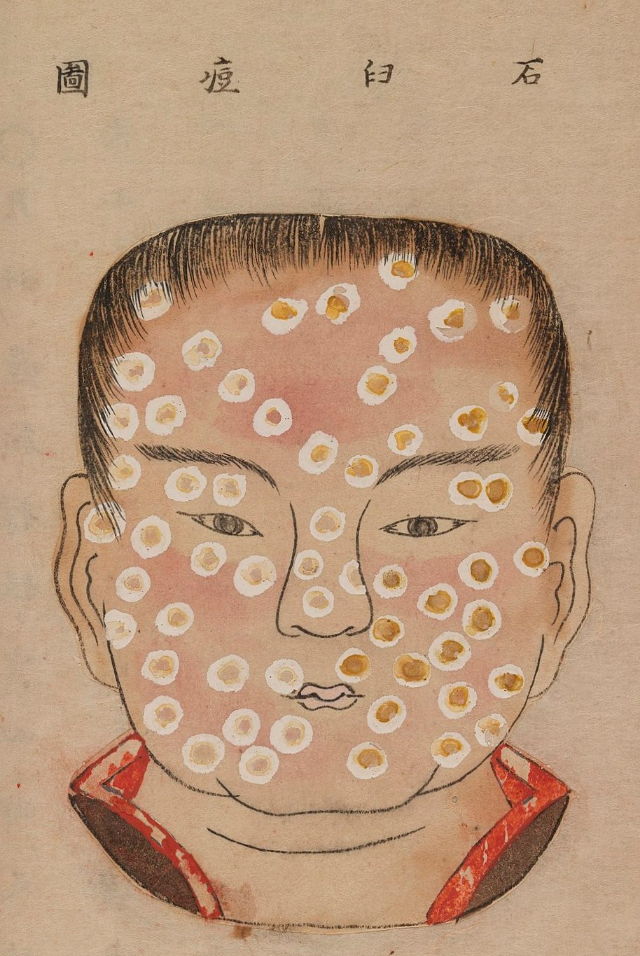 1720 Smallpox Illustration 30