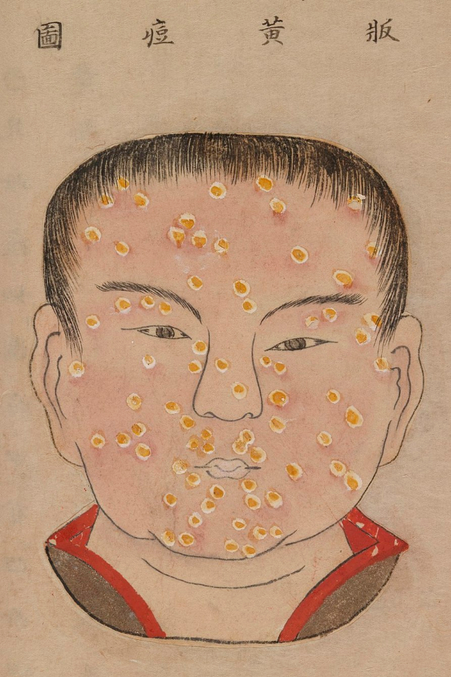 1720 Smallpox Illustration 31