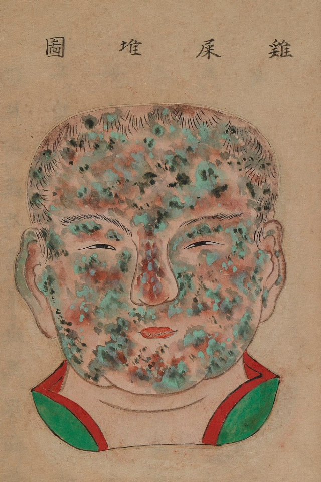 1720 Smallpox Illustration 35