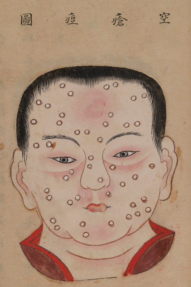 1720 Smallpox Illustration 36