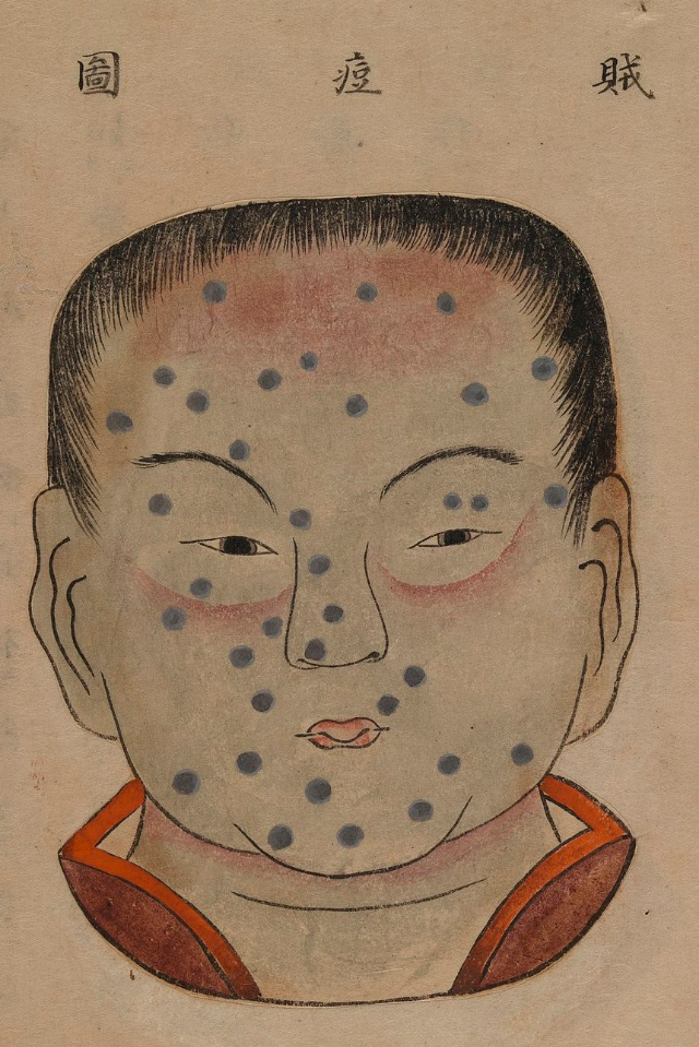 1720 Smallpox Illustration 37
