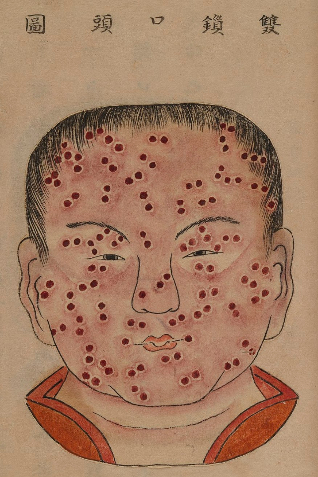1720 Smallpox Illustration 38