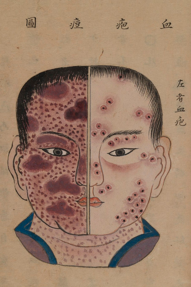 1720 Smallpox Illustration 39