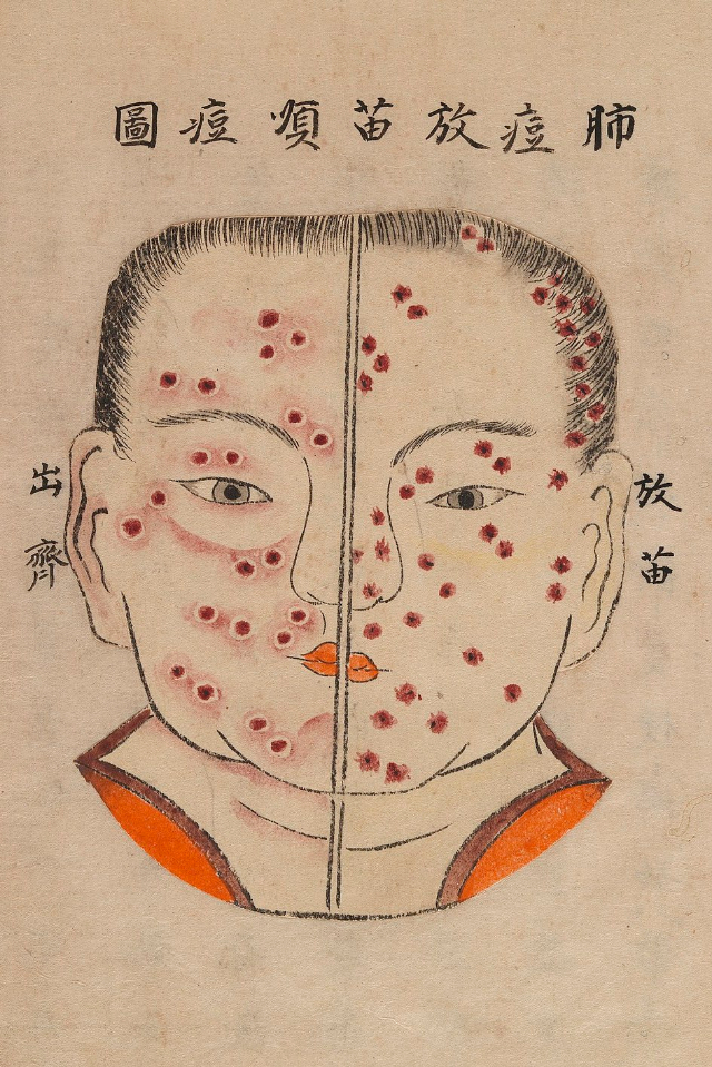 1720 Smallpox Illustration 4