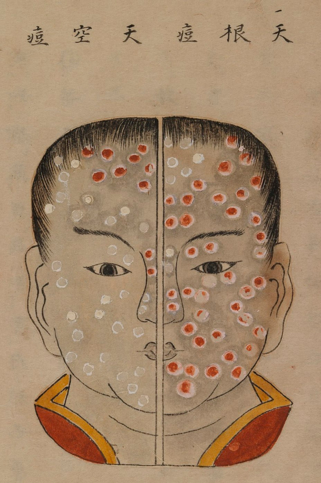 1720 Smallpox Illustration 40