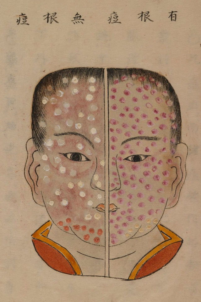 1720 Smallpox Illustration 41