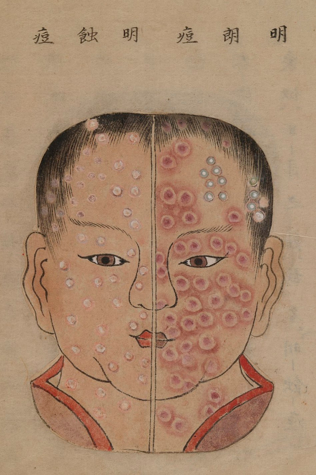 1720 Smallpox Illustration 42