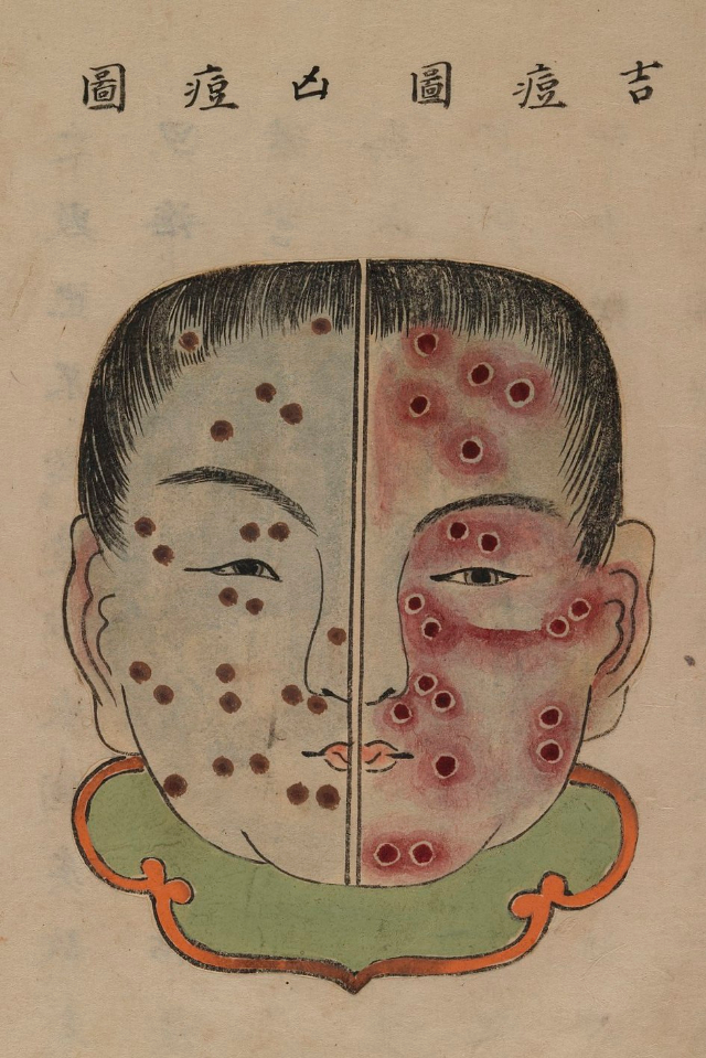 1720 Smallpox Illustration 43